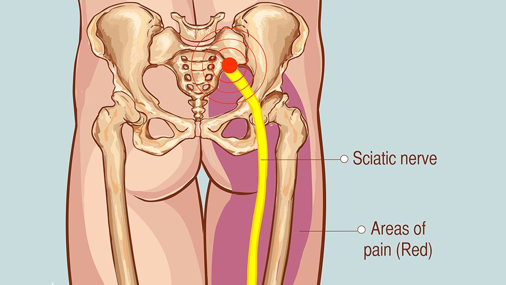Sciatic nerve compression